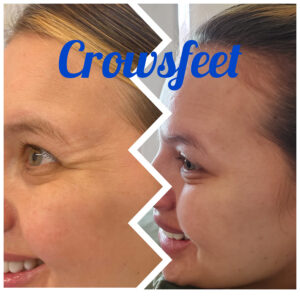 crows-feet