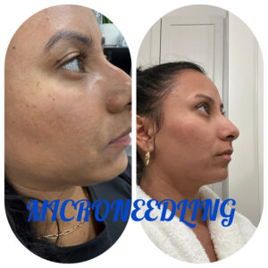microneedling