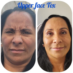 upper-face-tox